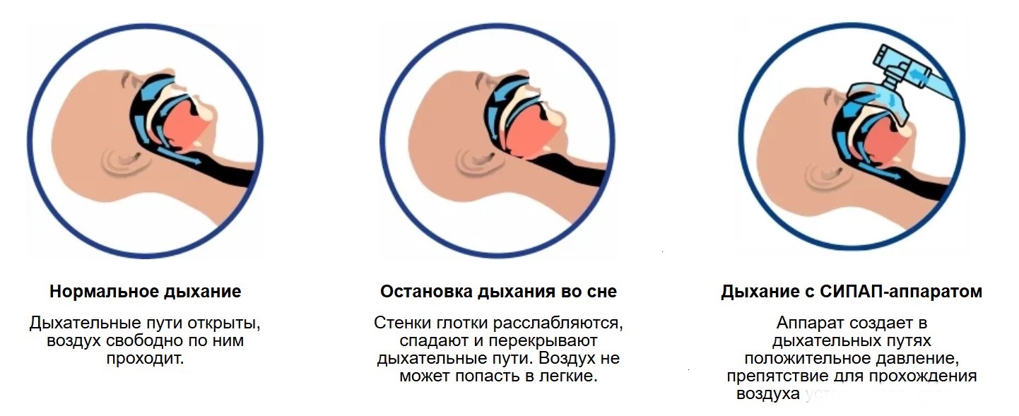 Три состояния дыхательных путей: нормальное дыхание, остановка дыхания во сне, дыхание с СИПАП-аппаратом